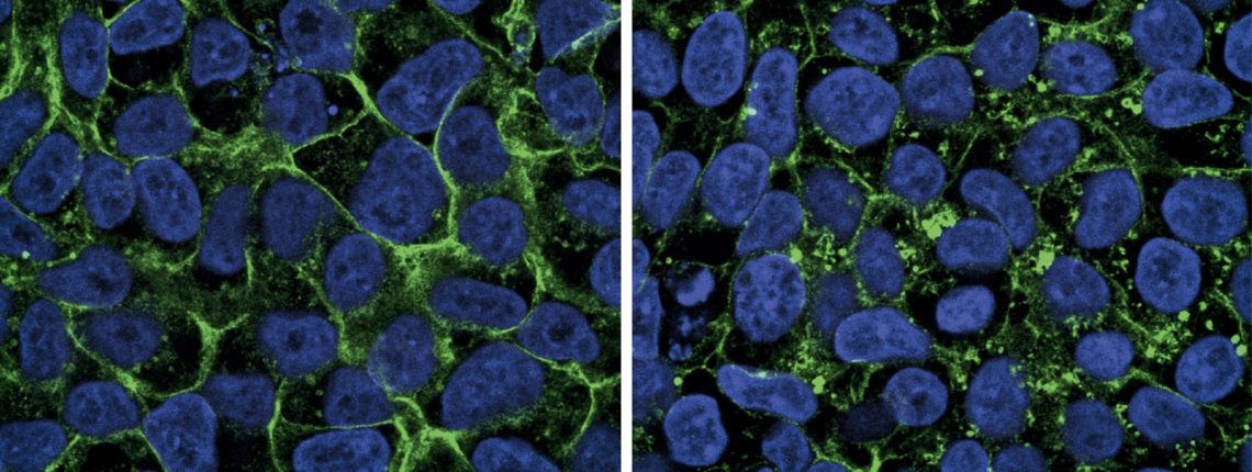 Unter dem Mikroskop sind links die Zellen eines gesunden Menschen zu sehen und rechts die von Macie. Sie leidet unter dem GLUT1-Defizit-Syndrom. Die Zuckertransporter (GLUT1) fluoreszieren grün. Bei gesunden Menschen befinden sie sich in den Zellhüllen (blau: Zellkern). In Macies Fall ist nur ein Teil der Transporter in diesen Membranen. Der Zuckertransport ist daher stark beeinträchtigt